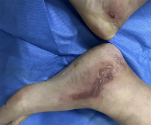 女子为防蚊往鞋里倒敌敌畏：双脚布满水泡走路困难