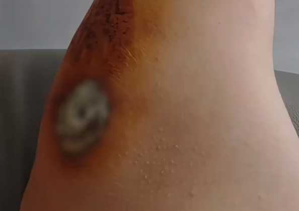 女子伤口似发霉听网友劝连夜就医 属凝血过程中正常现象