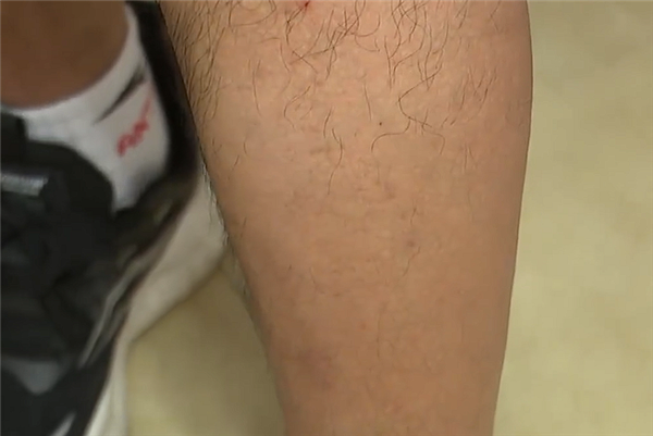 男子怀疑汽车静电导致自己双腿脱毛：4S售后主管都听懵了