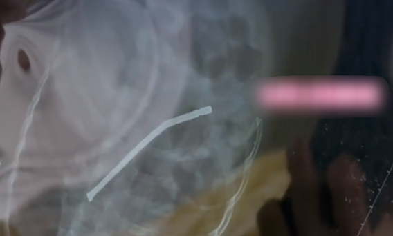 3岁娃吞下40多颗磁力珠致胃穿孔 奶奶以为能自行排出